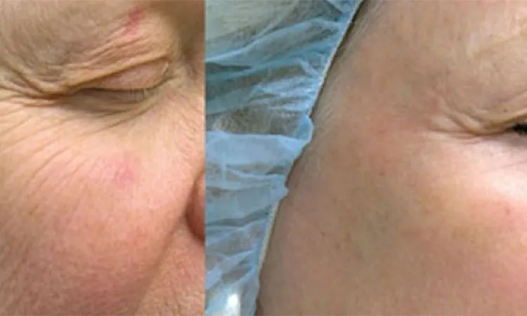 مراقبت‌های قبل و بعد از استفاده از لیزر CO2 فرکشنال