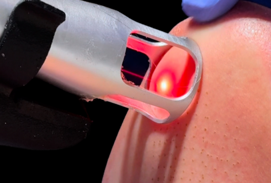 لیزر کورینگ (Laser Coring)