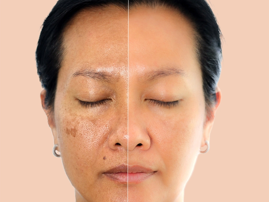 مزایای لیزر CO2 فرکشنال