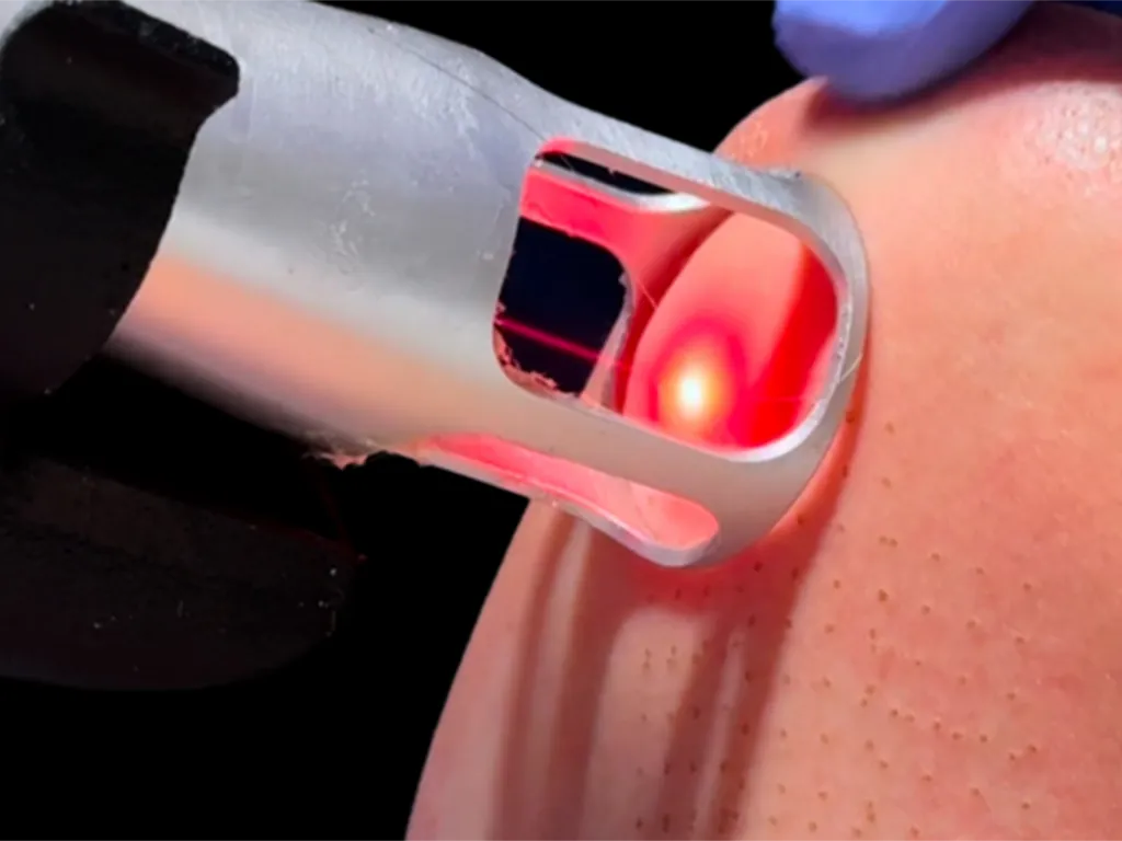 لیزر کورینگ