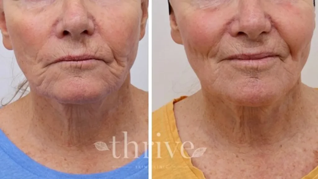 لیزر کورینگ