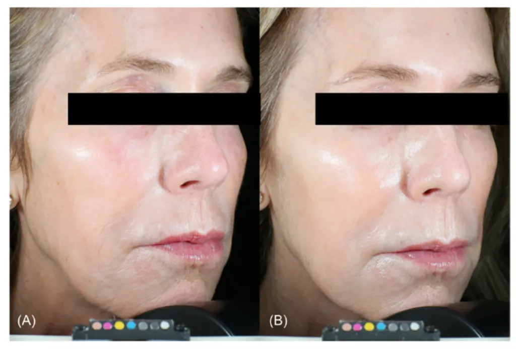 لیزر اولترا کلیر