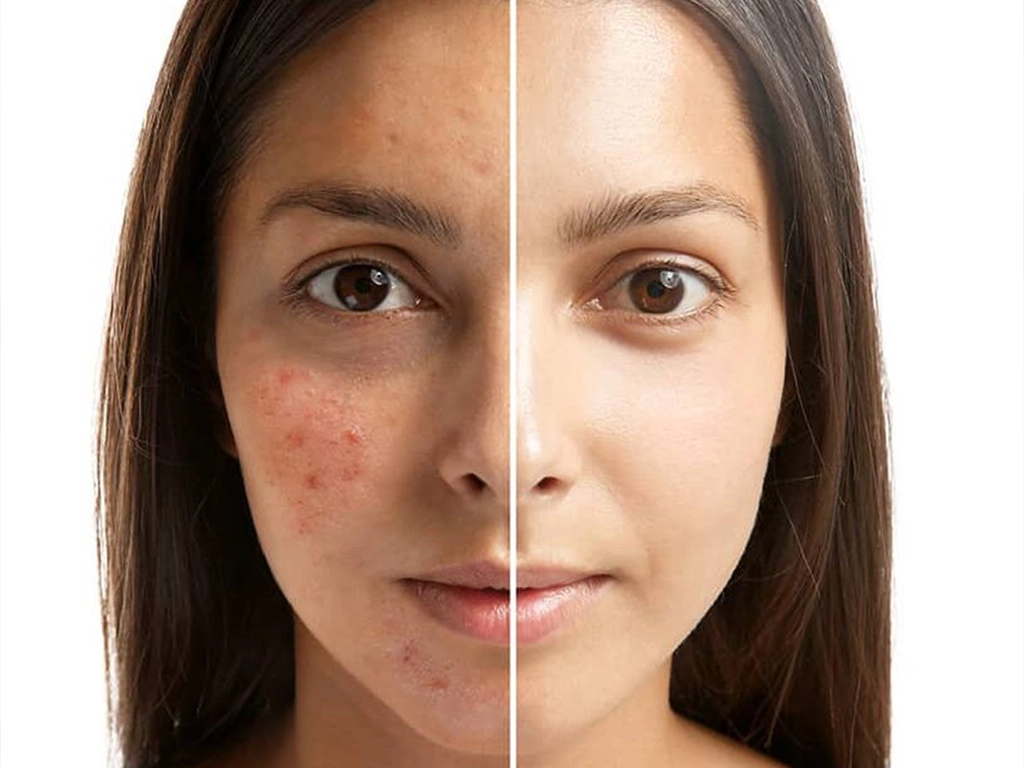 درمان اسکار و جای جوش با لیزر؛ روشهای علمی و ایمن 3 درمان اسکار و جای جوش با لیزر