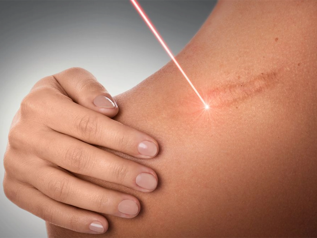 لیزر درمانی در پزشکی و زیبایی؛ کاربردها و مزایا