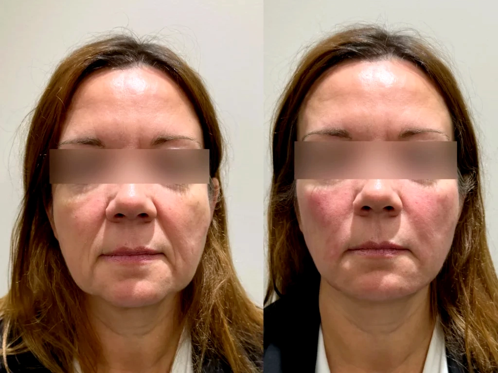 لیفت صورت بدون جراحی؛ روش‌های مدرن و ماندگار