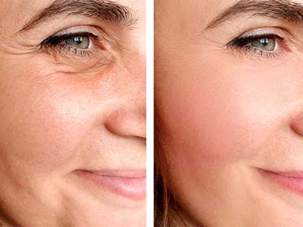 لیفت صورت بدون جراحی؛ روش‌های مدرن و ماندگار