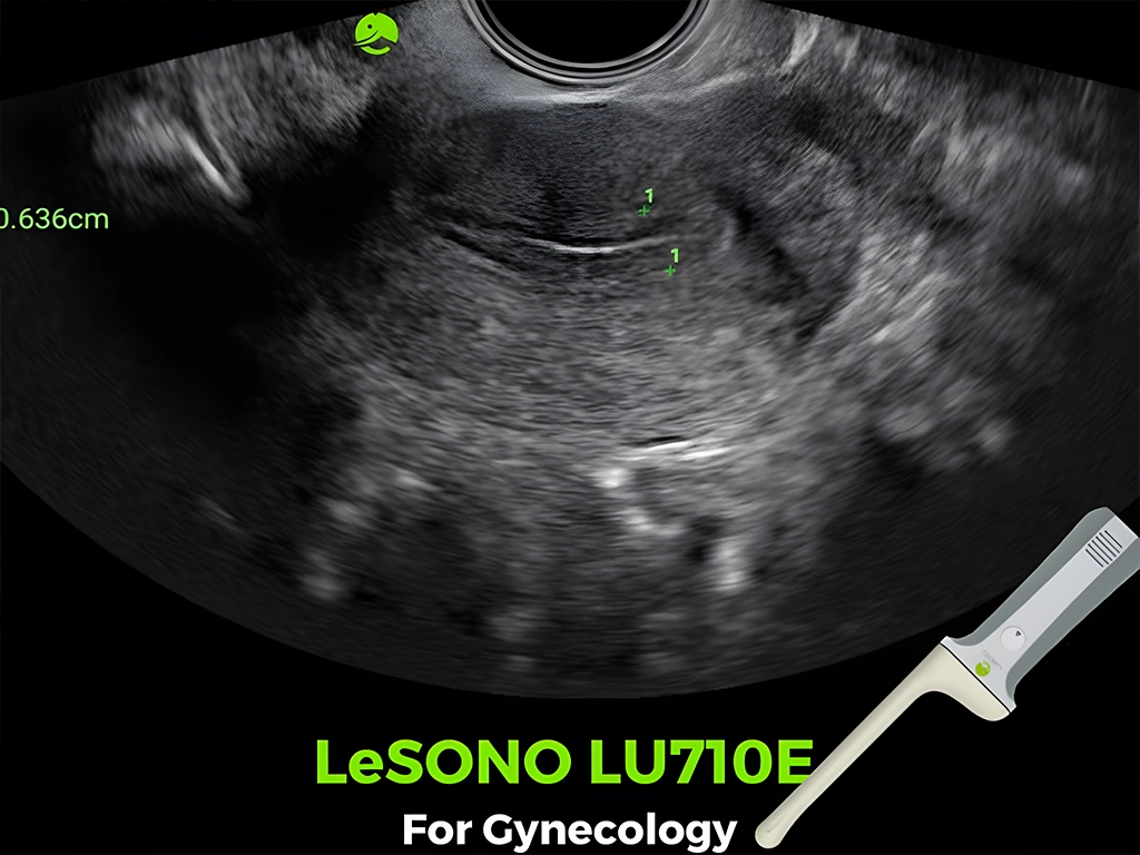 سونوگرافی واژینال: راهنمای جامع تشخیصی 3 سونوگرافی واژینال