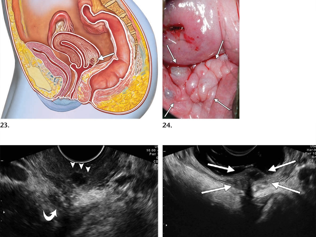 سونوگرافی اندومتریوز واژینال: راهکار پیشرفته تشخیص اندومتریوز با سونوگرافی ترانس واژینال لسونو 30 سونوگرافی واژینال برای تشخیص اندومتریوز