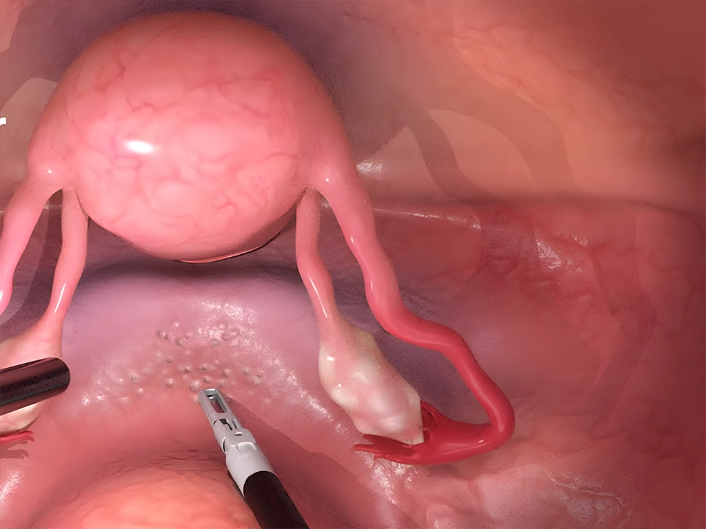 سونوگرافی اندومتریوز واژینال: راهکار پیشرفته تشخیص اندومتریوز با سونوگرافی ترانس واژینال لسونو 29 سونوگرافی واژینال برای تشخیص اندومتریوز