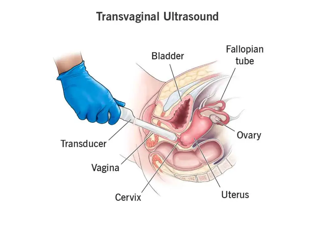 سونوگرافی واژینال: راهنمای جامع تشخیص با سونوگرافی ترانس واژینال لسونو 11 سونوگرافی ترانس واژینال