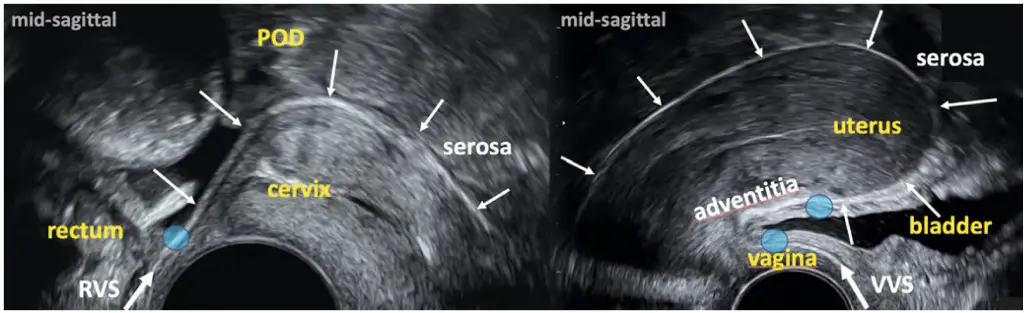 سونوگرافی اندومتریوز واژینال: راهکار پیشرفته تشخیص اندومتریوز با سونوگرافی ترانس واژینال لسونو 27 سونوگرافی اندومتریوز واژینال