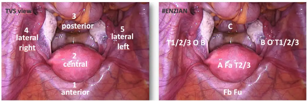 سونوگرافی اندومتریوز واژینال: راهکار پیشرفته تشخیص اندومتریوز با سونوگرافی ترانس واژینال لسونو 28 سونوگرافی اندومتریوز واژینال