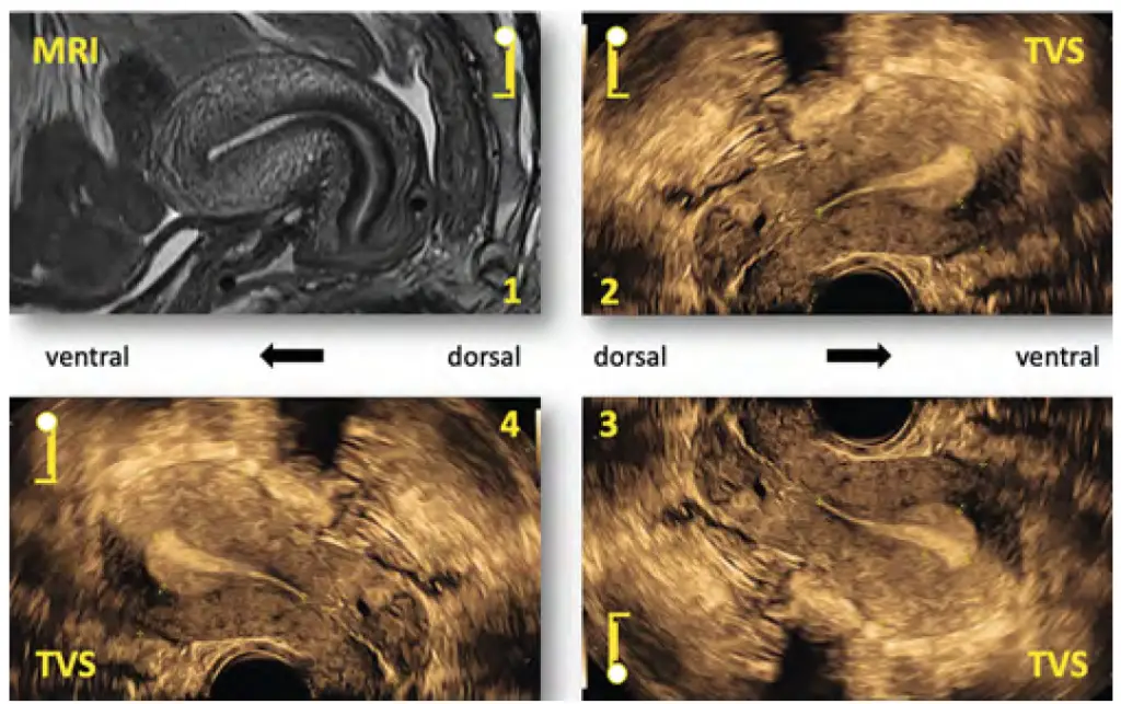 سونوگرافی اندومتریوز واژینال: راهکار پیشرفته تشخیص اندومتریوز با سونوگرافی ترانس واژینال لسونو 26 سونوگرافی اندومتریوز واژینال
