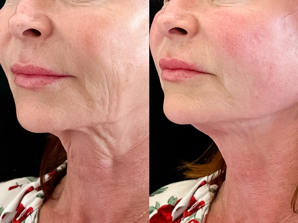 شلی پوست گردن چرا ایجاد می‌شود و چگونه درمان می‌شود؟